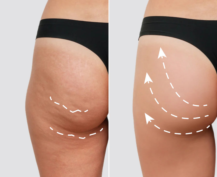 <p>Bye Cellulite</p>